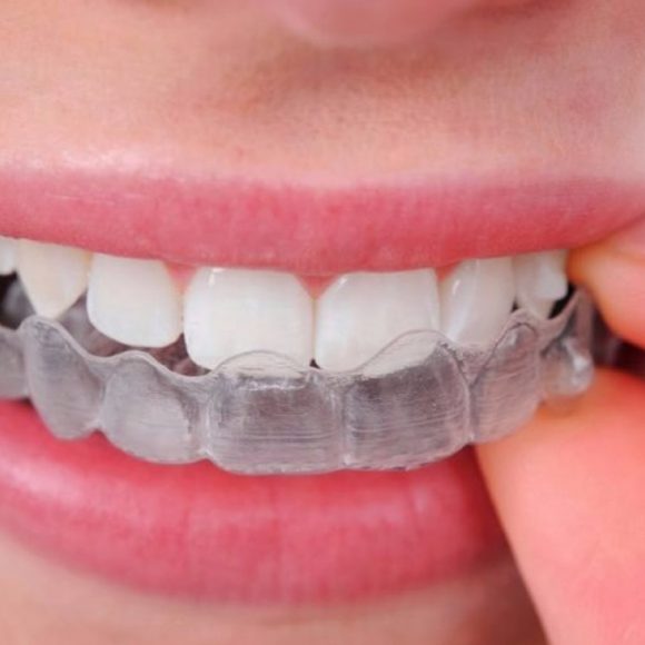 Ortodonzia – Apparecchi per denti