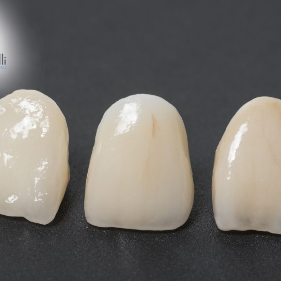 Sbiancamento ed estetica dentale