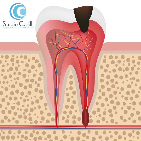 otturazione-denti-messina