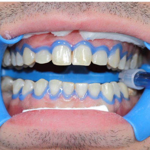 sbiancamento-denti