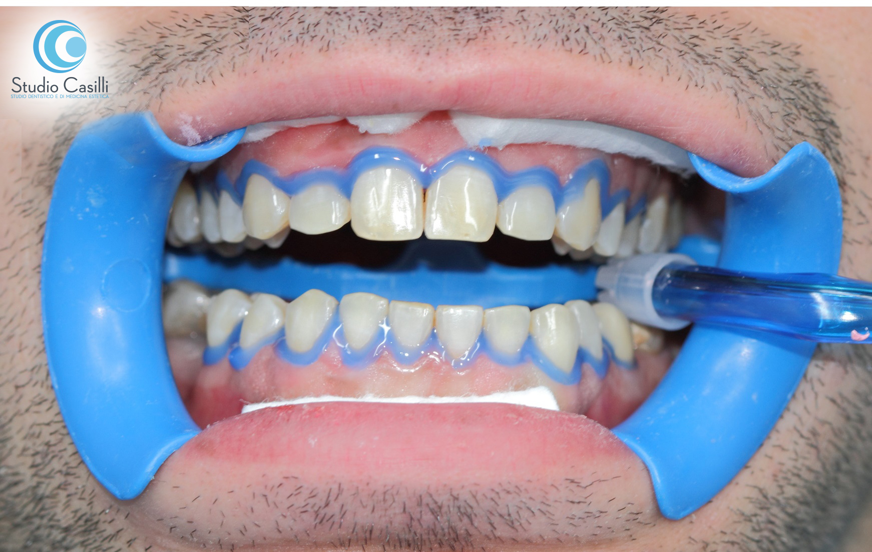 Sbiancamento ed estetica dentale Sbiancamento ed estetica dentale